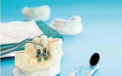 Cuidados y mantenimiento de implantes dentales