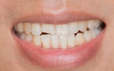 Fractura dental