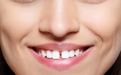 Diastema: Qué es y cómo corregirlo en nuestras clínicas dentales en Madrid