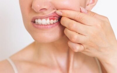 ¿Qué es la gingivitis y cómo puedes tratarla?