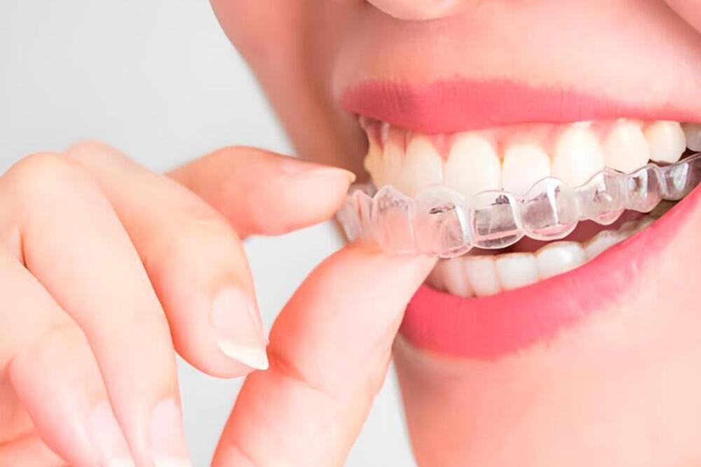 ortodoncia ferula de contencion garantia dental