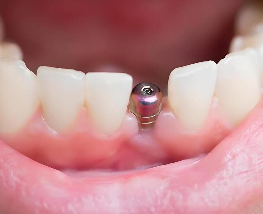 vista cenital tornillo diente post implante min